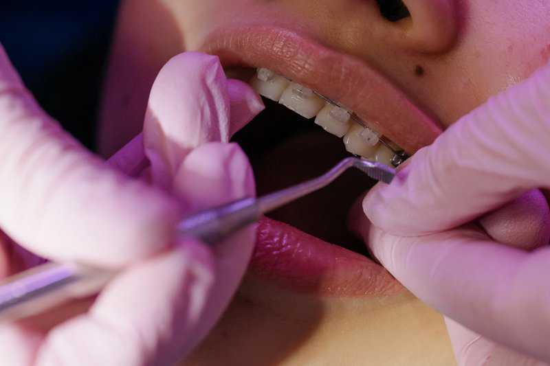 Maintaining Oral Health During Orthodontic Treatment: Tips and Advice